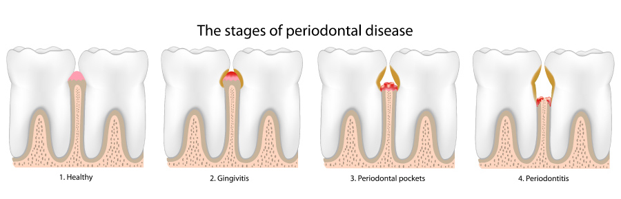 Artistic rendering of the stages of periodontal or gum disease