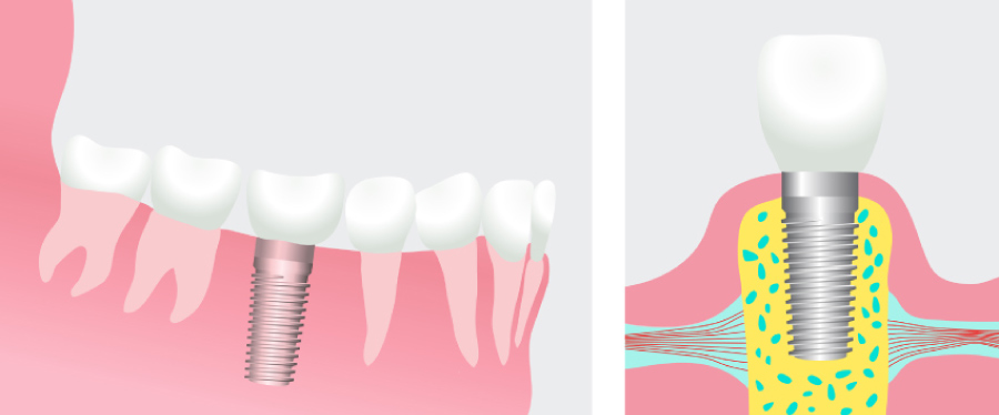 Graphic illustration showing the two steps of dental implant restoration
