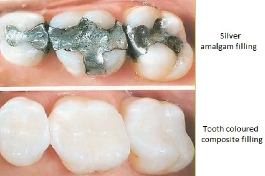 Photo showing amalgam fillings replaced with tooth colored composite fillings.