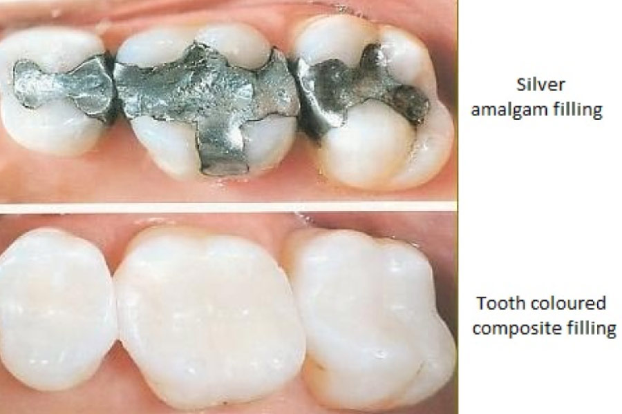 What Is The Safe Mercury Amalgam Removal Technique