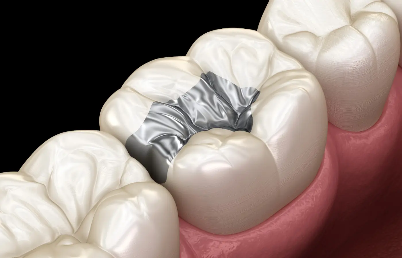 is it ok to take glutathione with mercury fillings Safe Amalgam Filling Removal in Newbury Park, CA Preparing for Mercury Filling Removal: