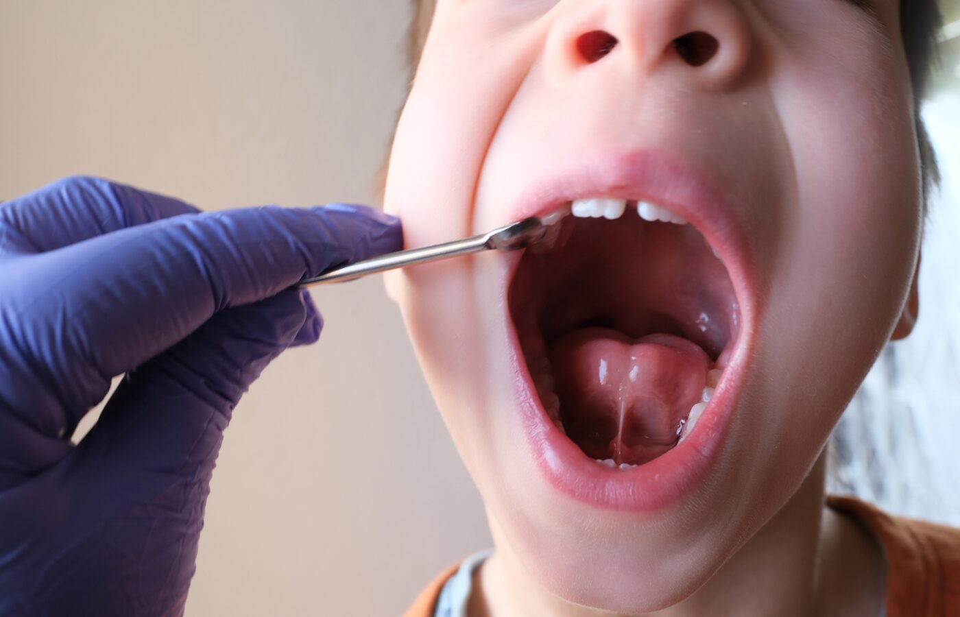 Image of a gloved hand examining the mouth of a child with a tongue tie