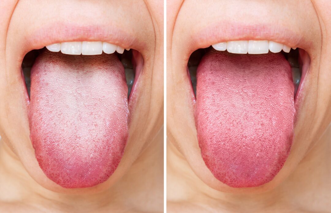 Photo of an unbrushed tongue next to a brushed tongue