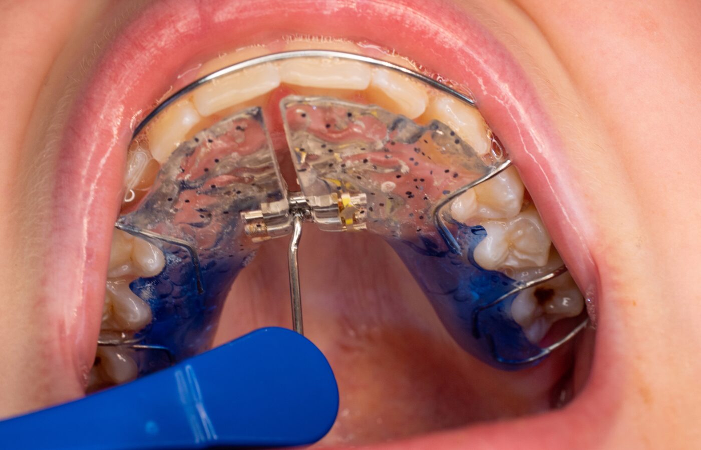 inside look at an expander being turned in a child’s mouth