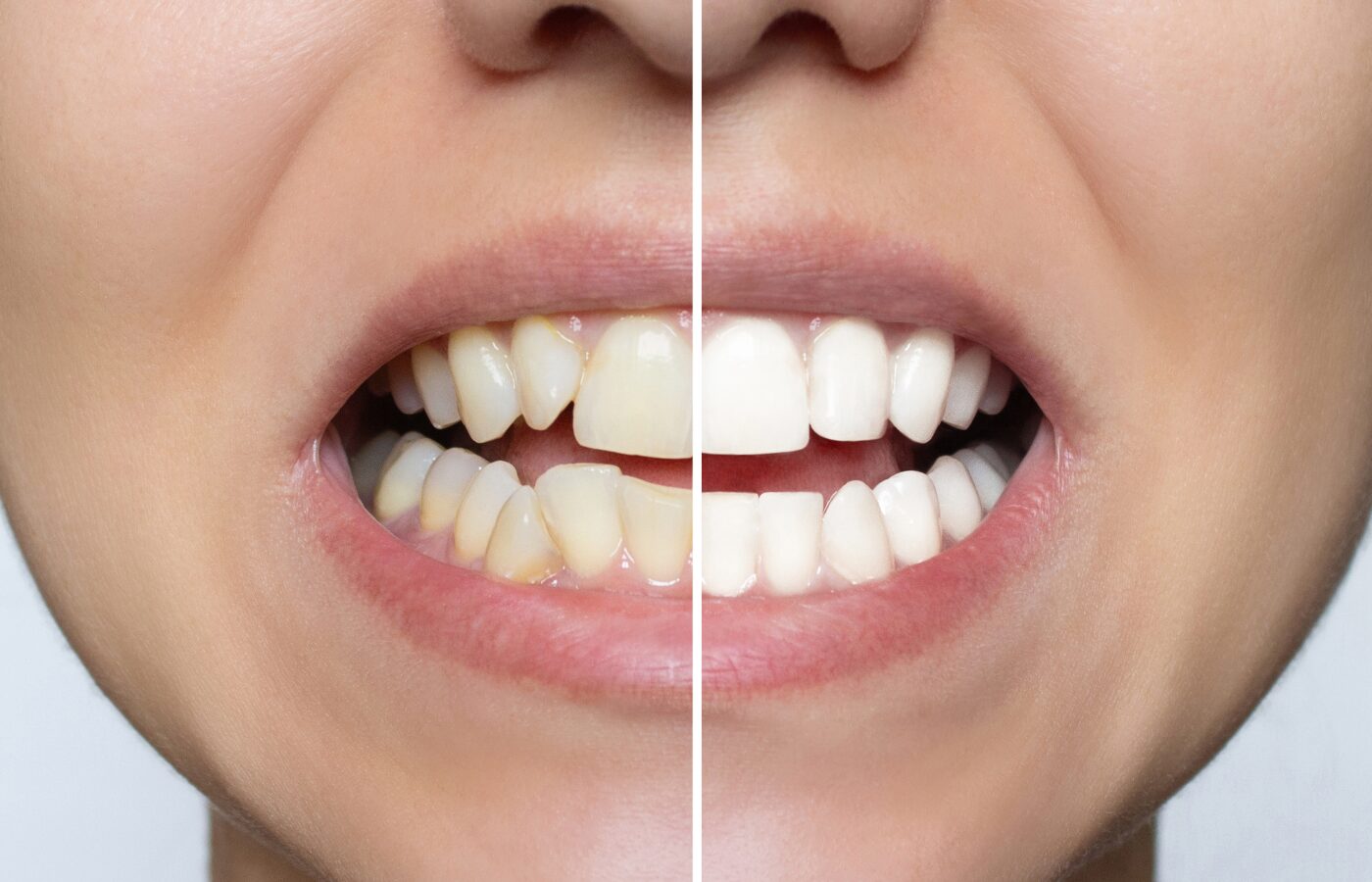 Side by side of how composite veneers improve teeth structure