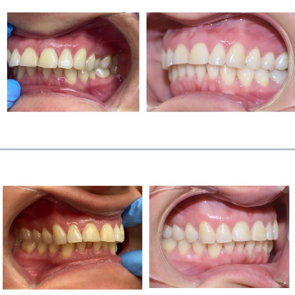 2 patient examples of the change expansive clear aligners made, the left being before and right after