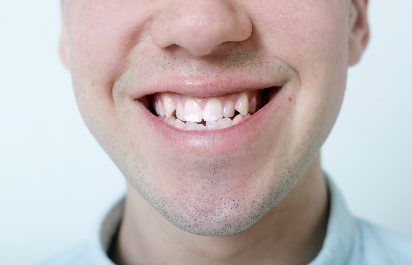 bottom half of mans face with mouth open showing teeth misaligned and narrow palate.