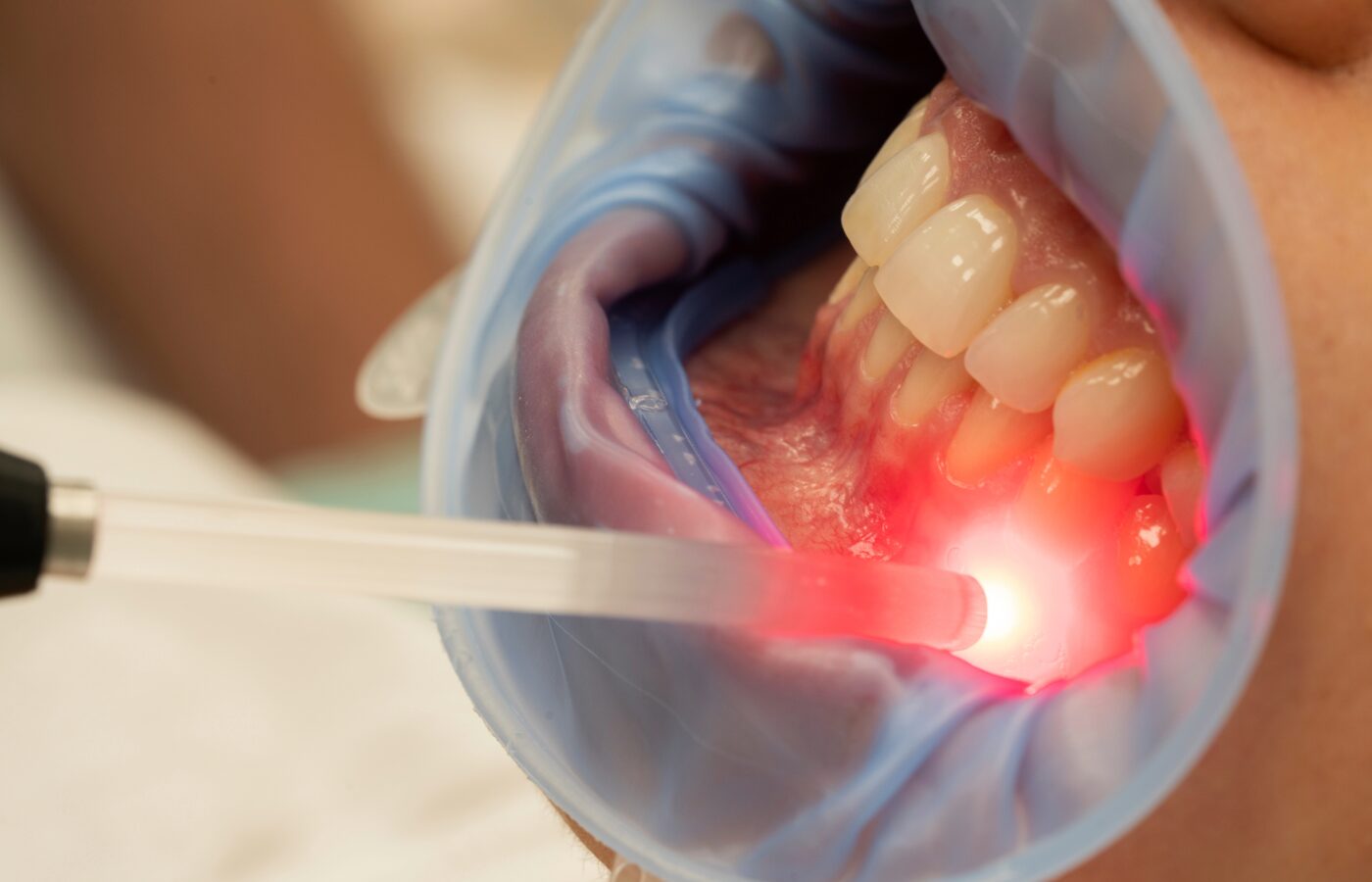 close up of a mouth with blue silicone around the mouth and a red light against the gums