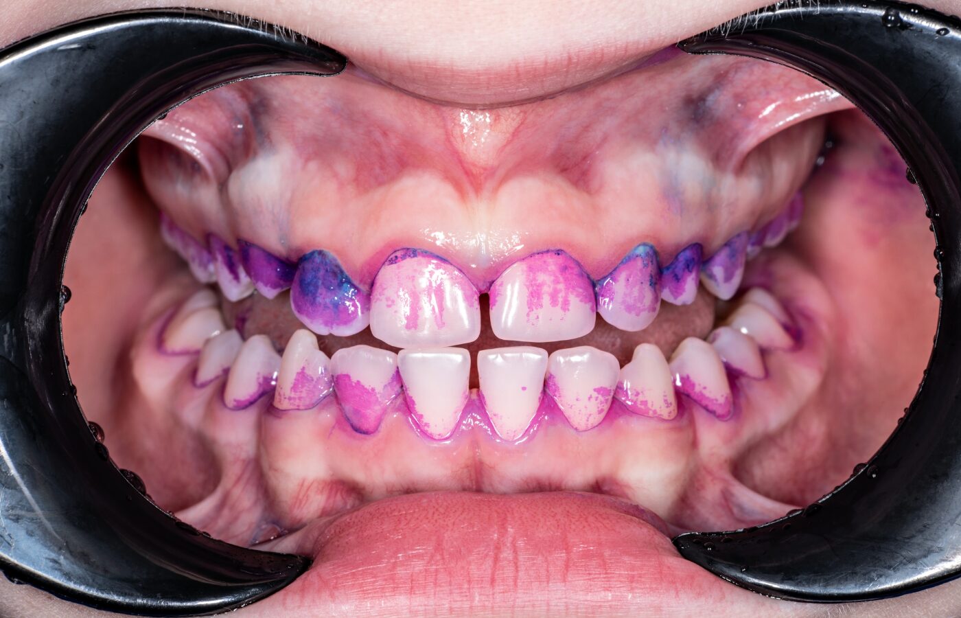 mouth open with tools and purple film on teeth to show where biofilm is