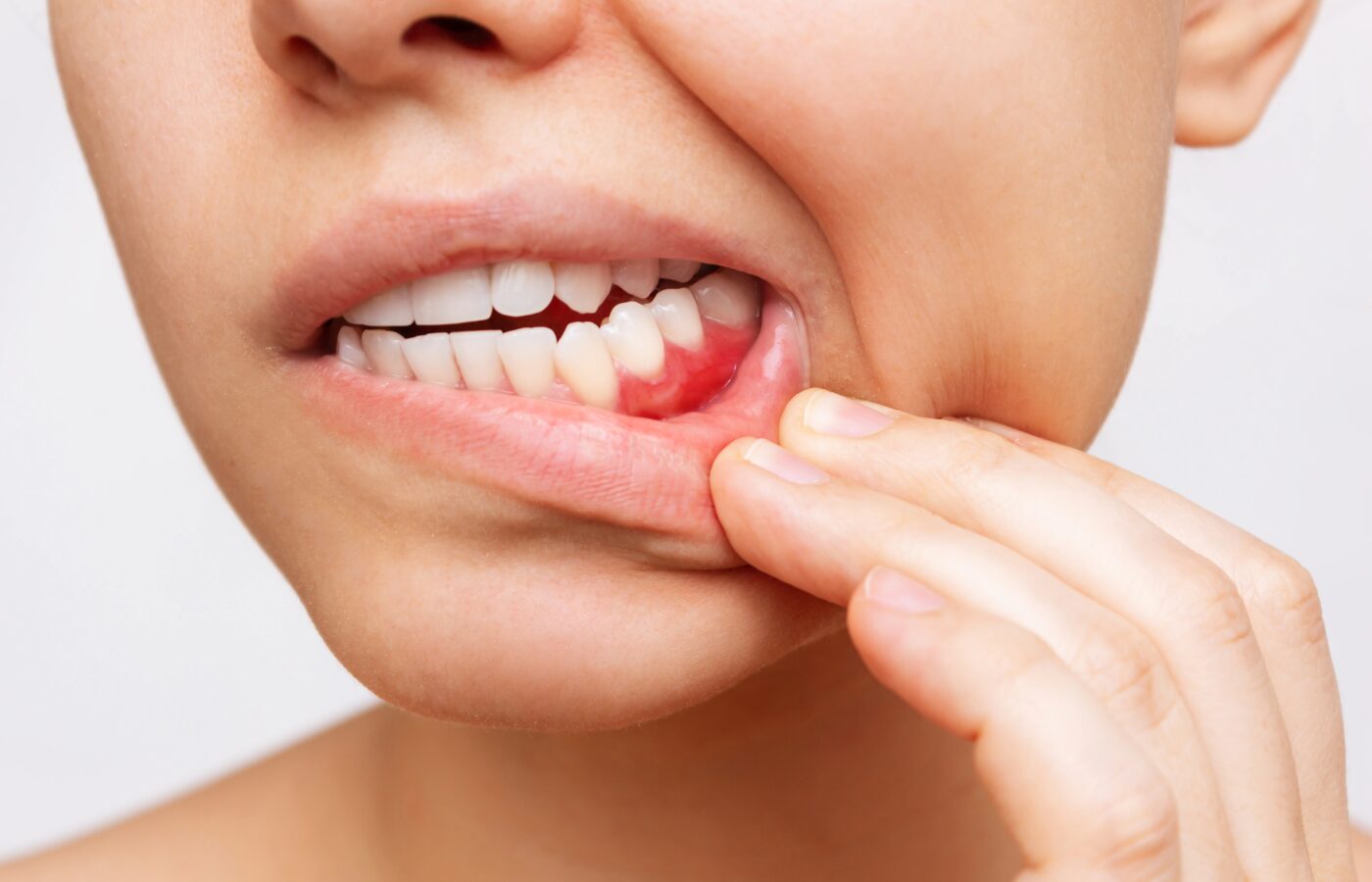 white woman’s mouth and nose shown and mouth open showing inflamed gums on the right side