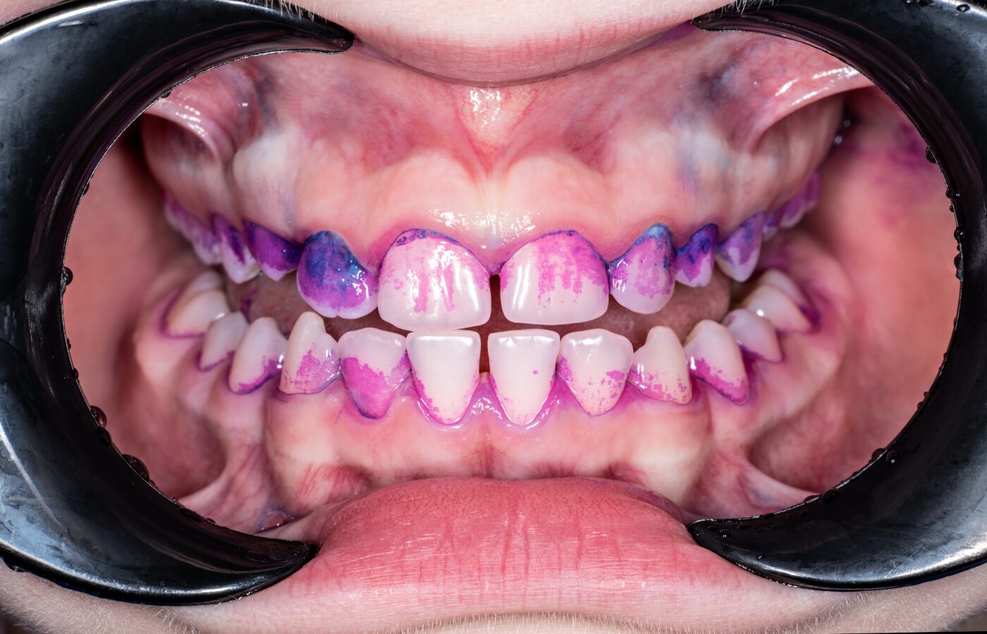 Mouth open with retractors showing purple disclosing solution highlighting biofilm buildup on teeth.